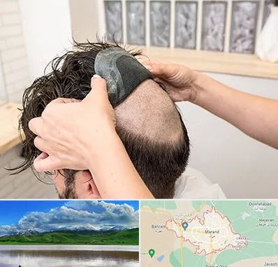 پروتز مو در مرند