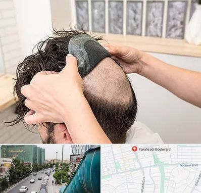 پروتز مو در بلوار فرحزادی