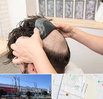 پروتز مو در فاز دو اندیشه