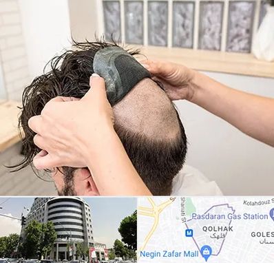 پروتز مو در قلهک 