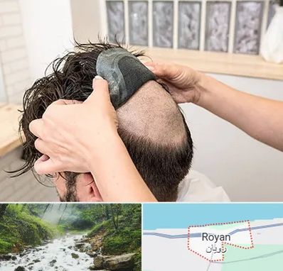 پروتز مو در رویان