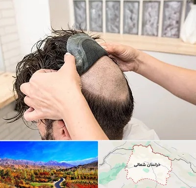 پروتز مو در خراسان شمالی