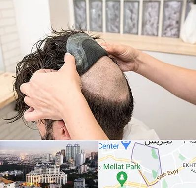 پروتز مو در الهیه 