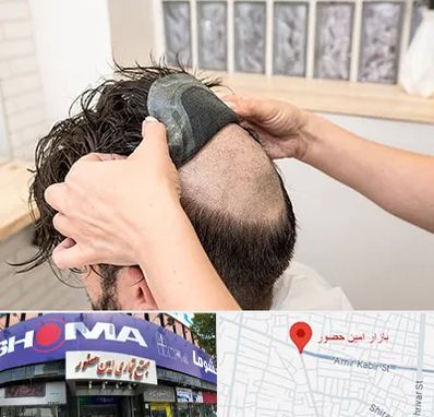 پروتز مو در امین حضور