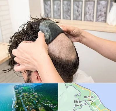 پروتز مو در رامسر