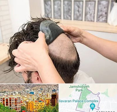 پروتز مو در نیاوران 