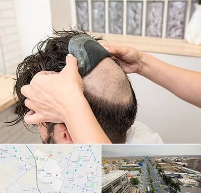 پروتز مو در حصارک کرج 