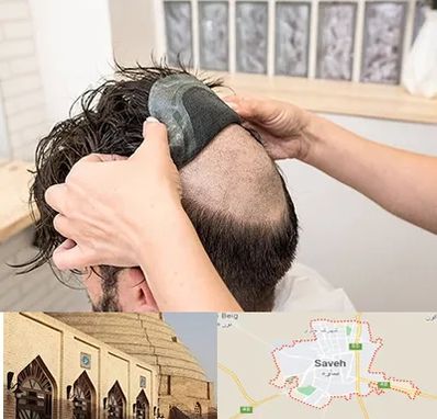 پروتز مو در ساوه