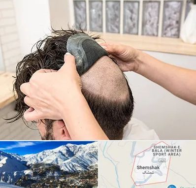 پروتز مو در شمشک