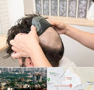 پروتز مو در عظیمیه کرج 