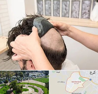 پروتز مو در مهرشهر کرج 