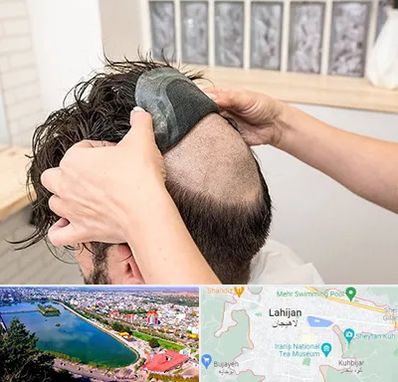 پروتز مو در لاهیجان