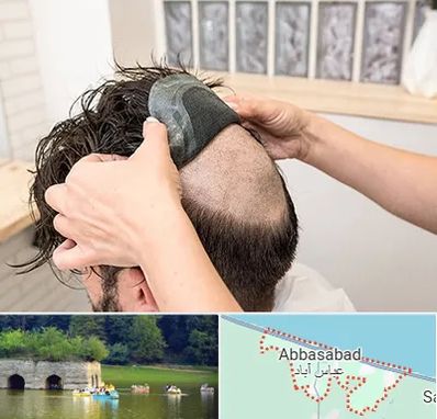 پروتز مو در عباس آباد