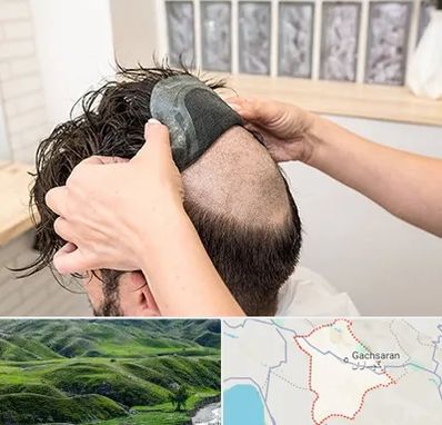 پروتز مو در گچساران