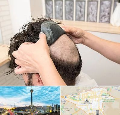 پروتز مو در تهران