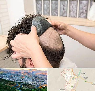 پروتز مو در سنندج