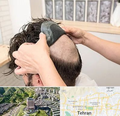 پروتز مو در شمال تهران 