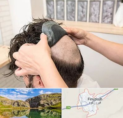 پروتز مو در فیروزکوه