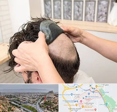 پروتز مو در معالی آباد شیراز 