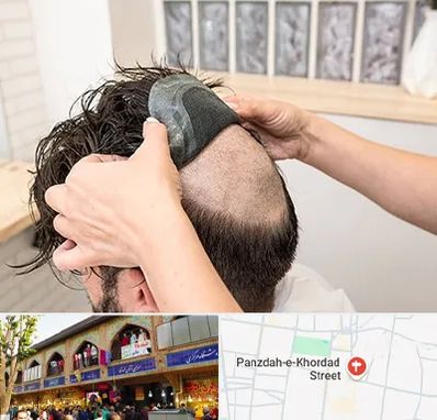 پروتز مو در 15 خرداد