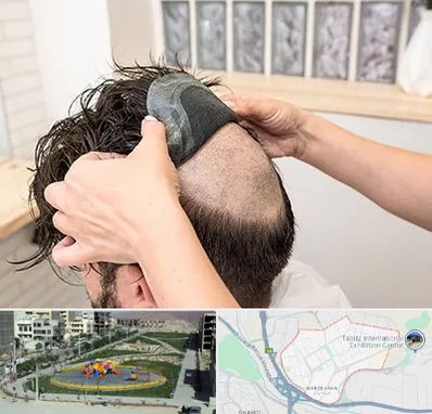 پروتز مو در مرزداران تبریز