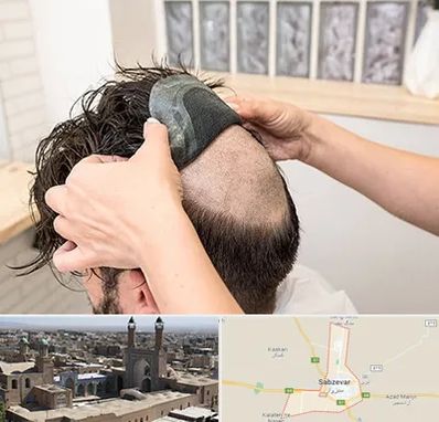 پروتز مو در سبزوار