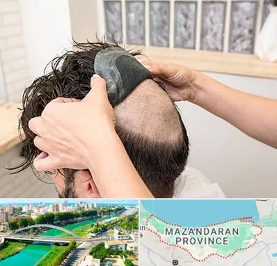 پروتز مو در مازندران