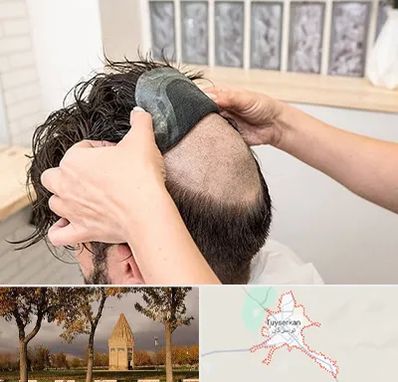 پروتز مو در تویسرکان