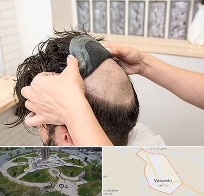 پروتز مو در ورامین