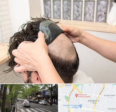 پروتز مو در ظفر 