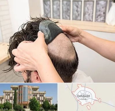 پروتز مو در دهدشت