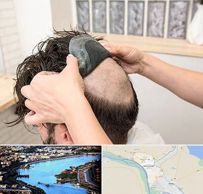 پروتز مو در خرمشهر