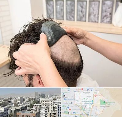 پروتز مو در منطقه 14 تهران 