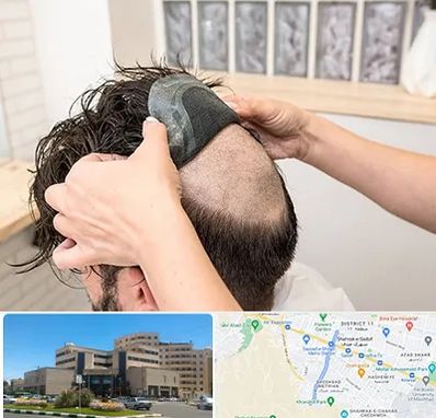 پروتز مو در صیاد شیرازی مشهد 