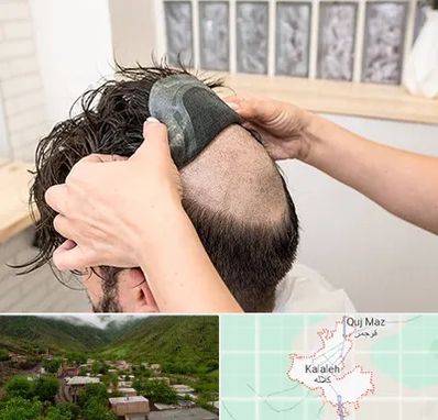 پروتز مو در کلاله