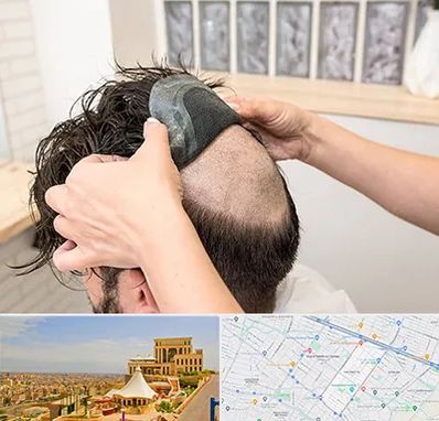 پروتز مو در هاشمیه مشهد 