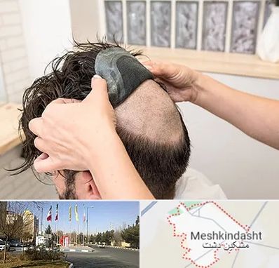 پروتز مو در مشکین دشت