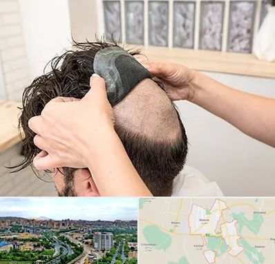 پروتز مو در شهریار