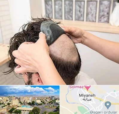 پروتز مو در میانه