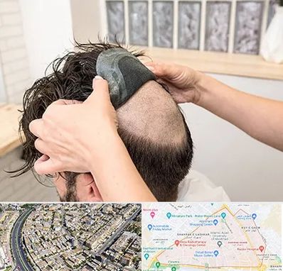 پروتز مو در شهرک غرب مشهد 