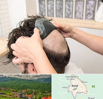 پروتز مو در آمل