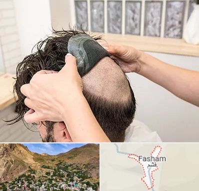 پروتز مو در فشم