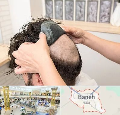 پروتز مو در بانه