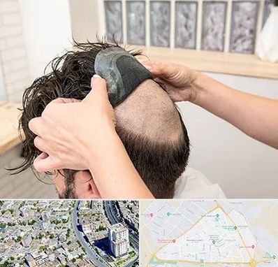 پروتز مو در قاسم آباد مشهد 