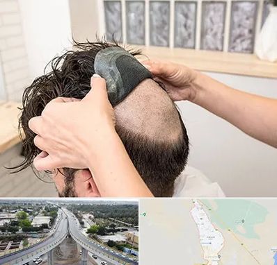 پروتز مو در اندیمشک