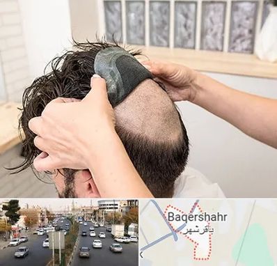 پروتز مو در باقرشهر