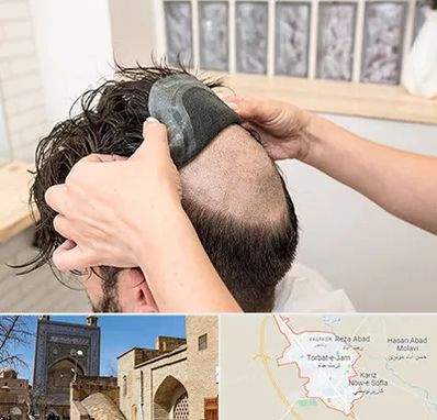 پروتز مو در تربت جام