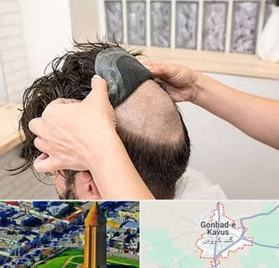 پروتز مو در گنبد کاووس