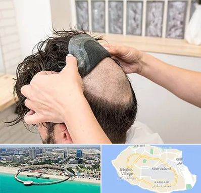 پروتز مو در کیش