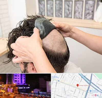 پروتز مو در آبرسان تبریز